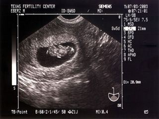 Mojo's Fetus 1